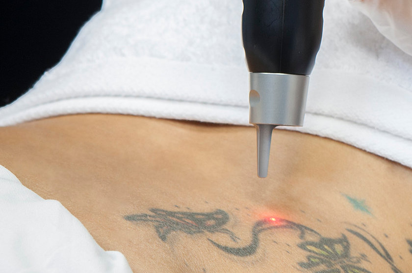 Laser-para-quitar-tatuajes