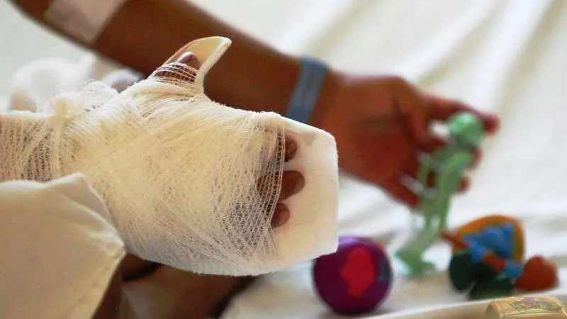 ni&ntilde;os quemados