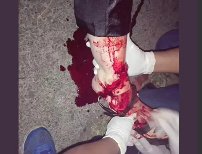 Herida en Santa Tecla