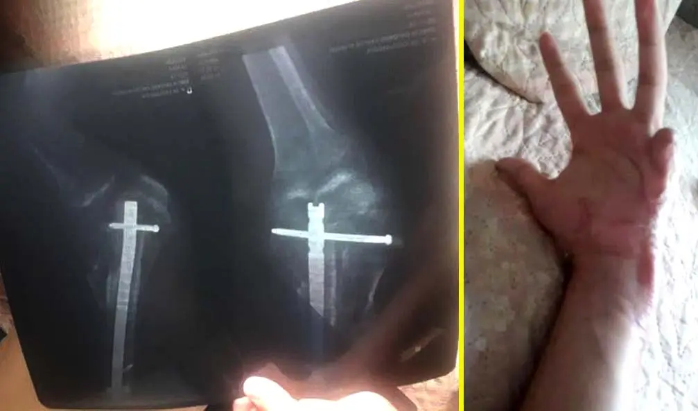 Da&ntilde;os en mano Foto tomada de Motociclista El Salvador 3