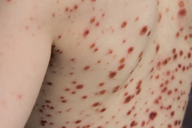 ampollas-viruela-mono