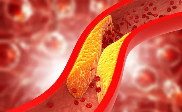 Colesterol en la sangre