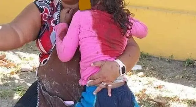 Niña mordida