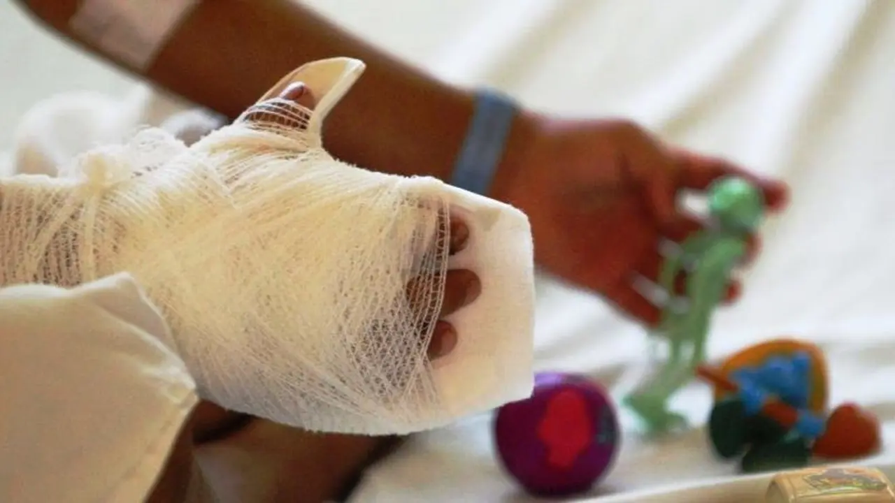 ni&ntilde;os quemados