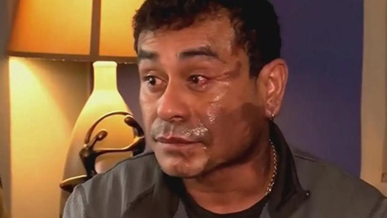 Hombre al que le lanzaron &aacute;cido en la cara