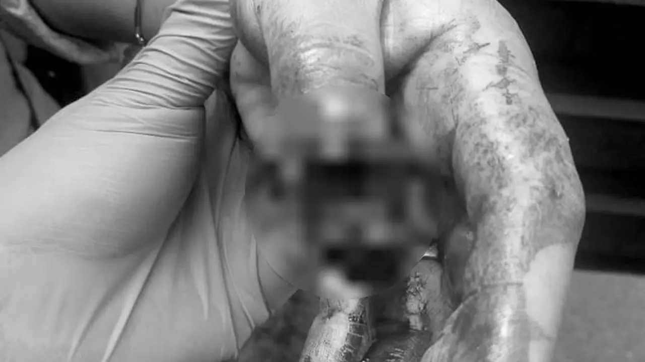 Le arrancan el dedo 2