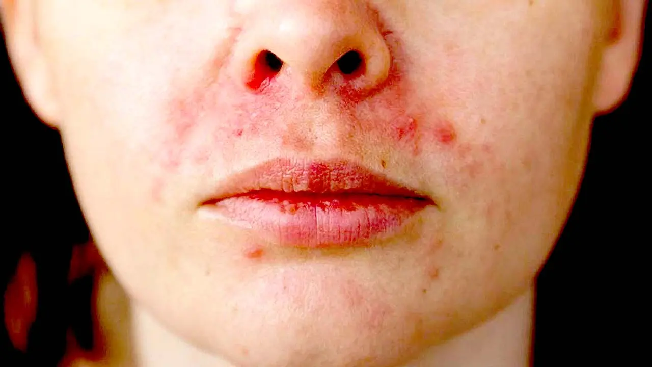 Problemas de hongos en boca por uso de mascarillas