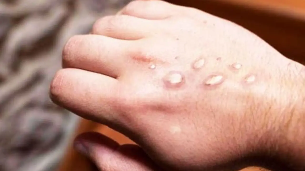 Viruela del mono en dos hombres