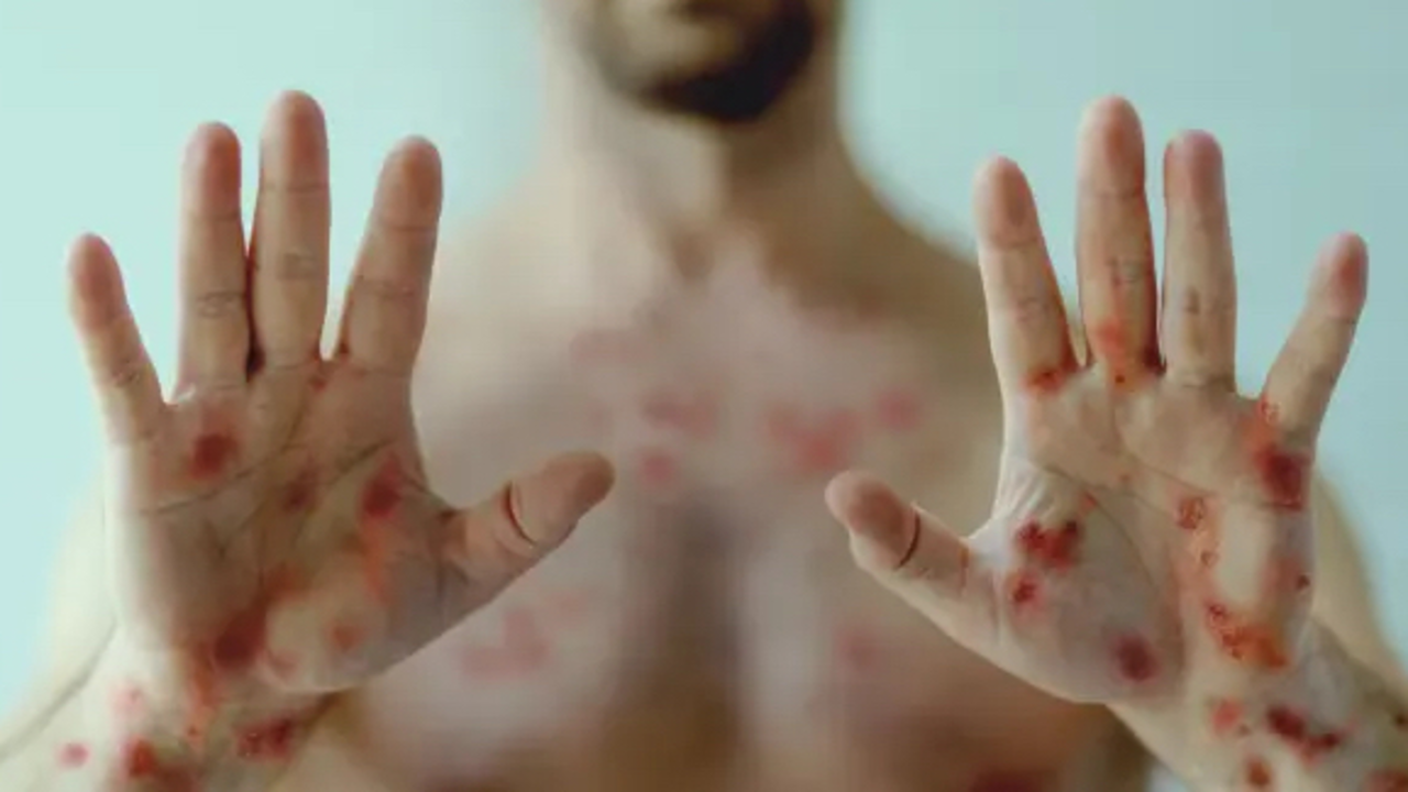 Viruela del Mono MPOX