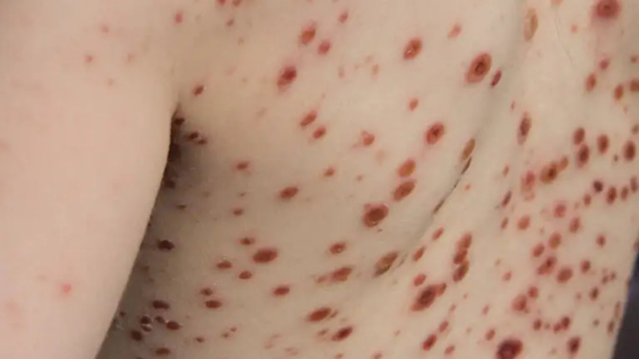 ampollas-viruela-mono