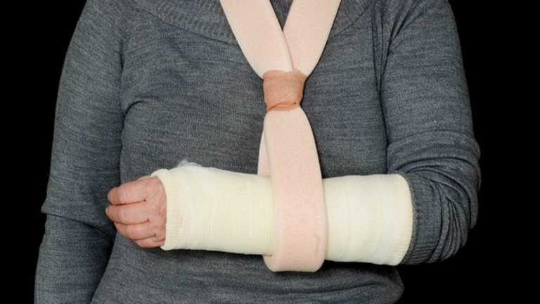 fractura en la  mano