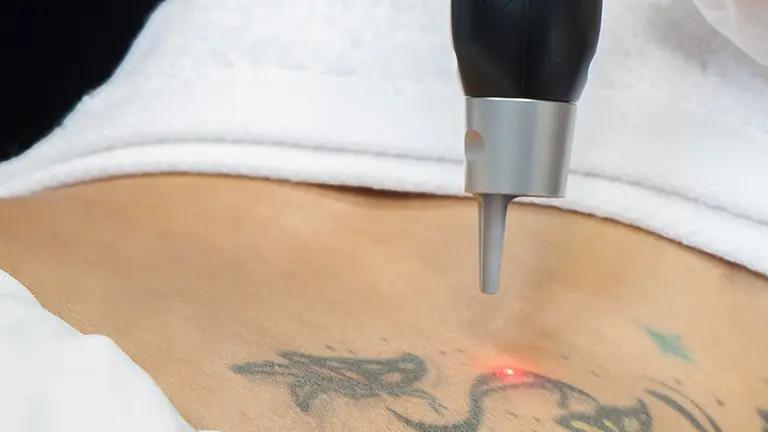 Laser-para-quitar-tatuajes
