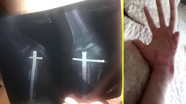 Daños en mano Foto tomada de Motociclista El Salvador 3