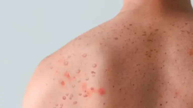 Quinto caso de viruela el Mono