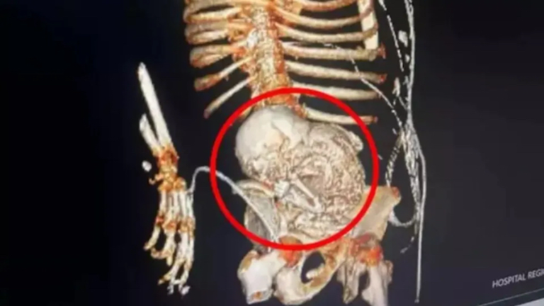 Brasil bebé calcificado copia