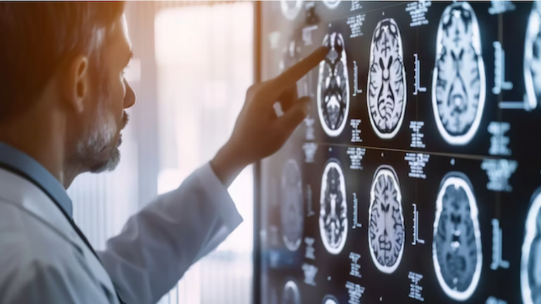 ACV Derrame Cerebral