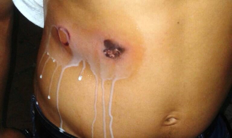 Personas con quemaduras tras fiestas patronales de Opico.